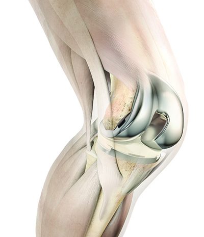 Cirugía Reconstructiva De Rodilla total colombia