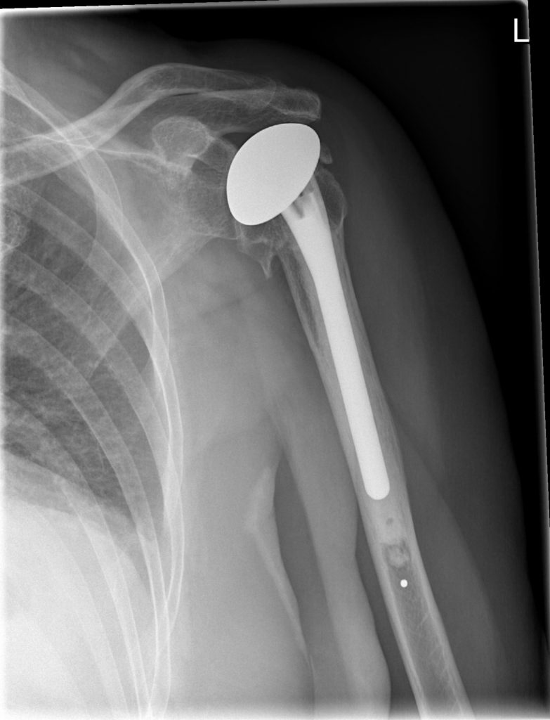 Shoulder Joint Replacements in colombia