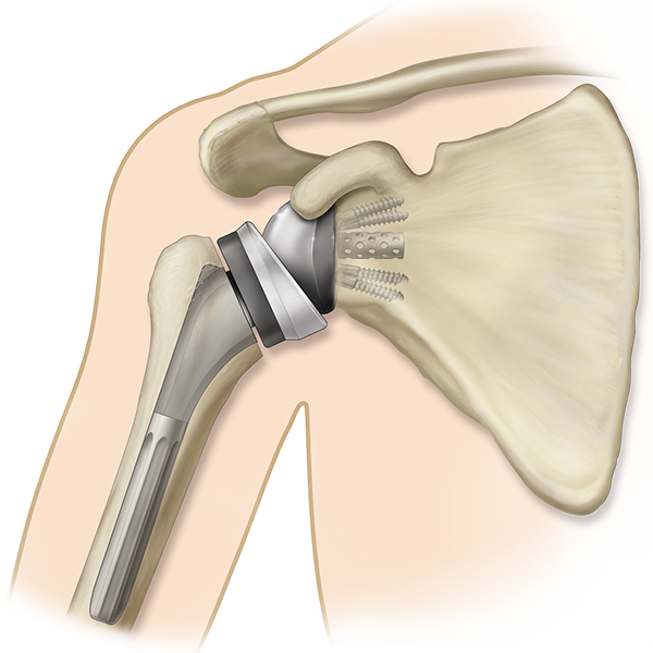 Shoulder Joint Replacements