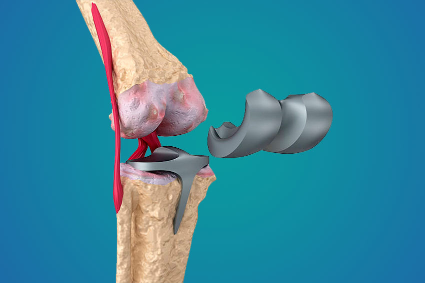 Reemplazos Articulares de Rodilla